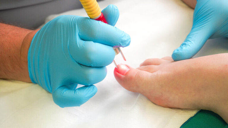 Fungal Nail Infection Treatment | Podiatrist Tips