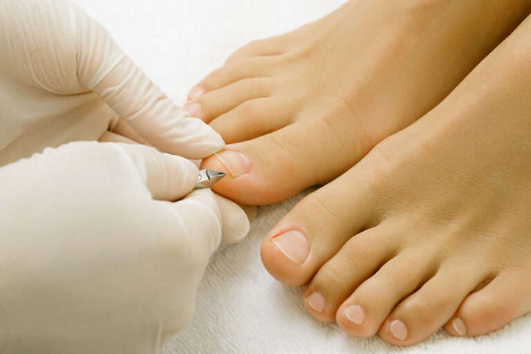 The Truth About Ingrown Toenails: Causes, Myths & Treatment Options